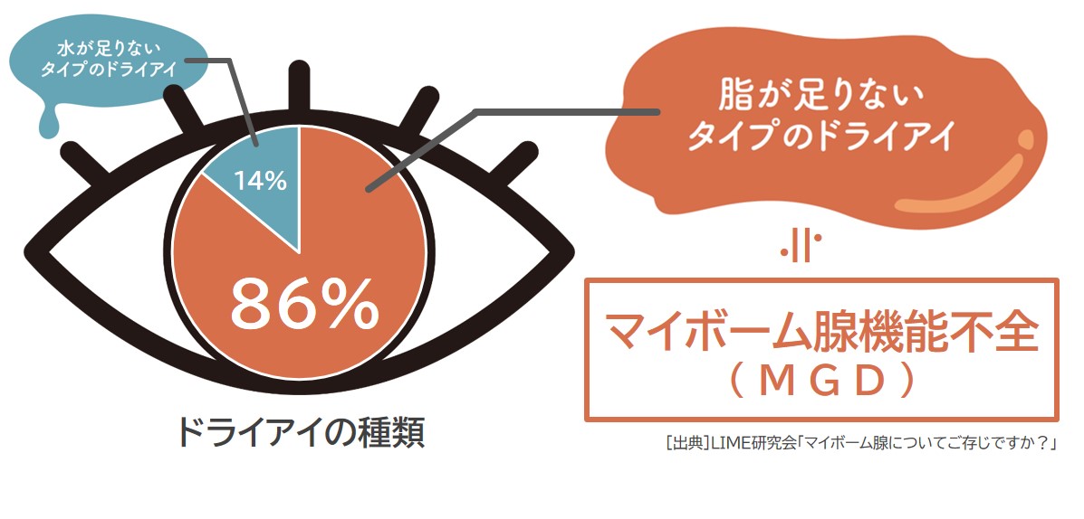 ドライアイの種類