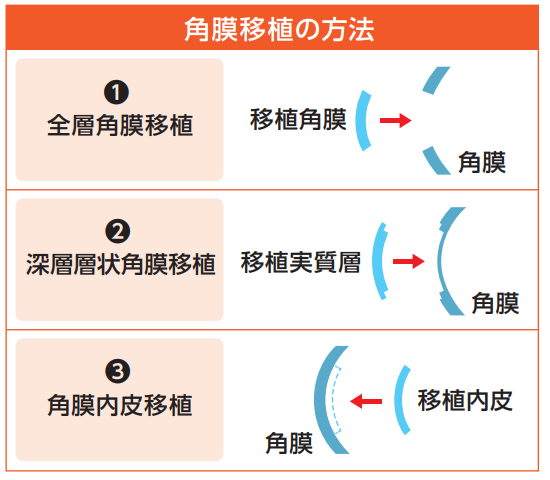 角膜移植の方法