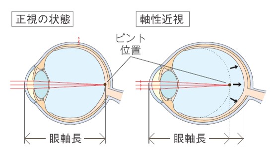 近視の説明