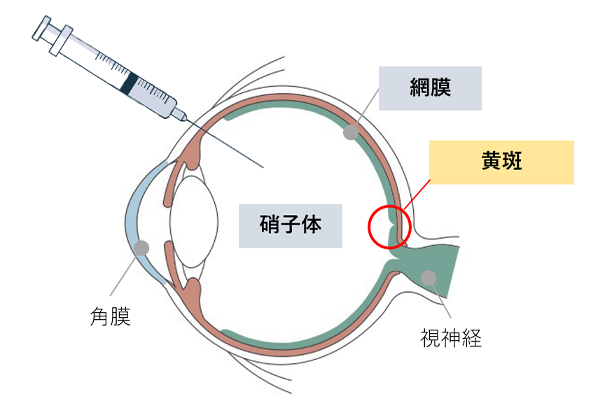 硝子体注射イメージ図