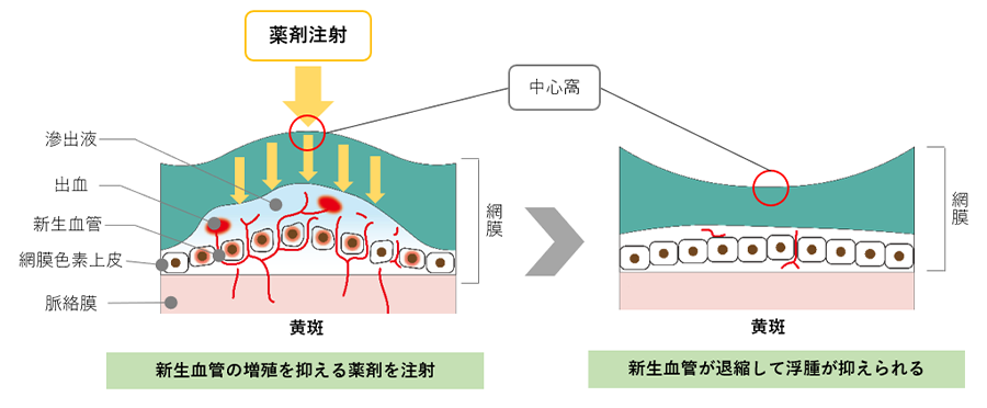 硝子体注射による薬効イメージ（加齢黄斑変性）