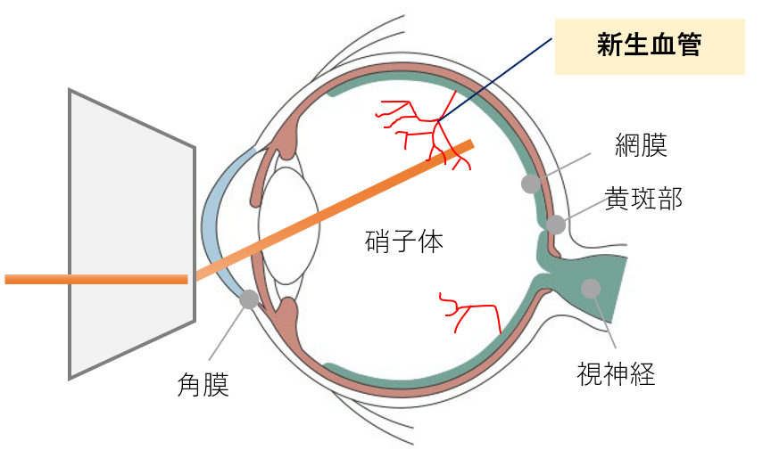 糖尿病性網膜症のケース