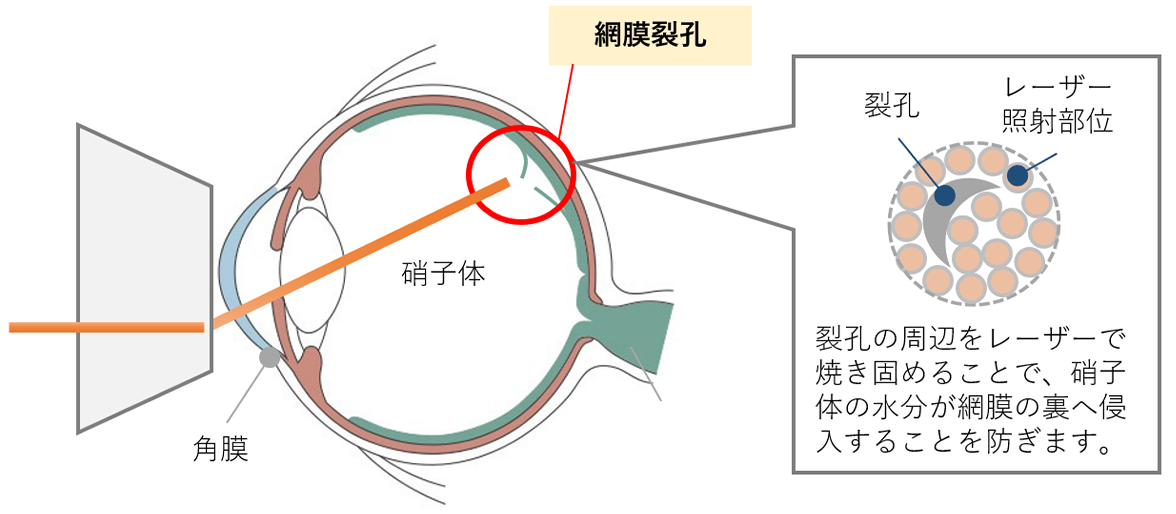 網膜裂孔のケース