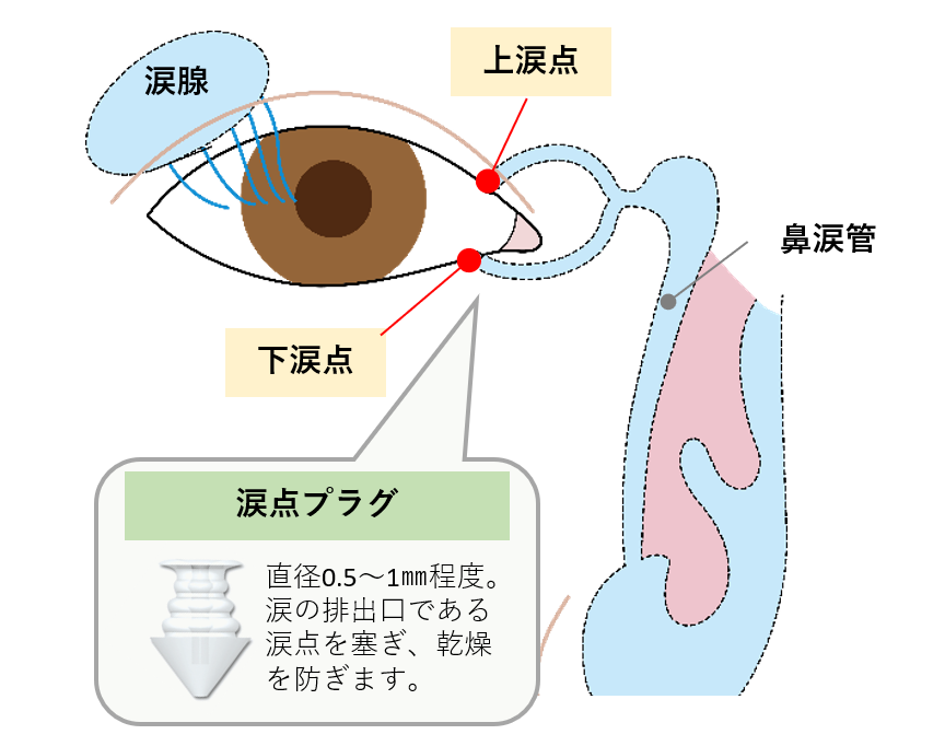 涙点プラグイメージ図